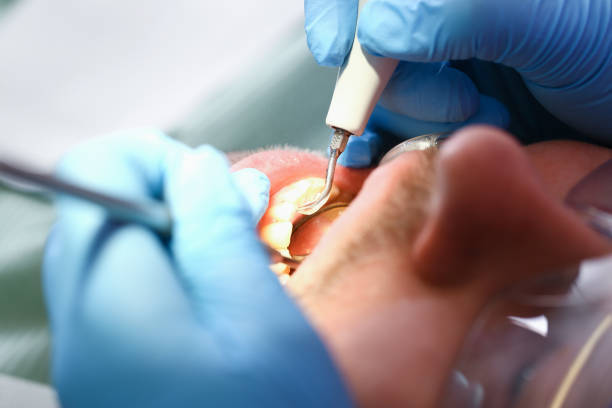 Best Emergency Tooth Extraction in National City, CA